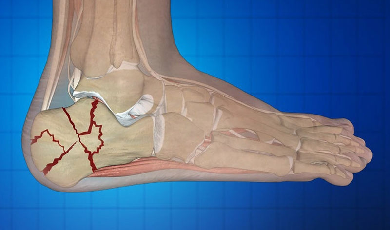 Các chấn thương khi đá bóng mà các cầu thủ hay gặp nhất 3