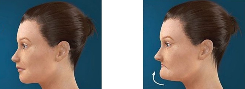 Giải đáp: Gãy xương hàm dưới có nguy hiểm không? 2