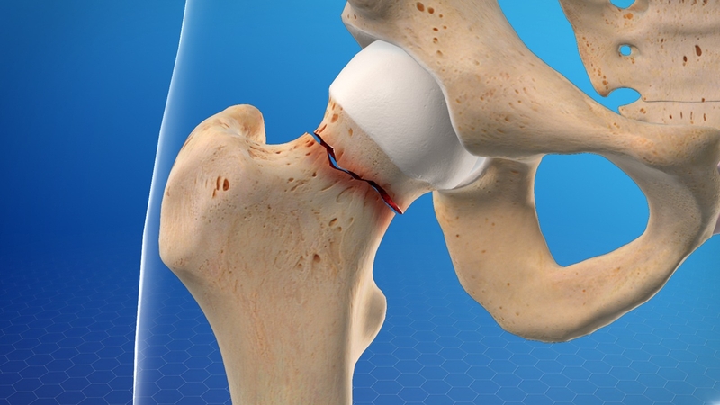Gãy xương hông do mỏi: Nguyên nhân, triệu chứng và cách điều trị