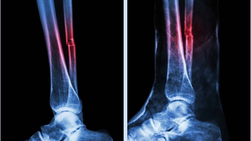 Gãy xương mác có đá bóng được không? Lời khuyên từ chuyên gia 1