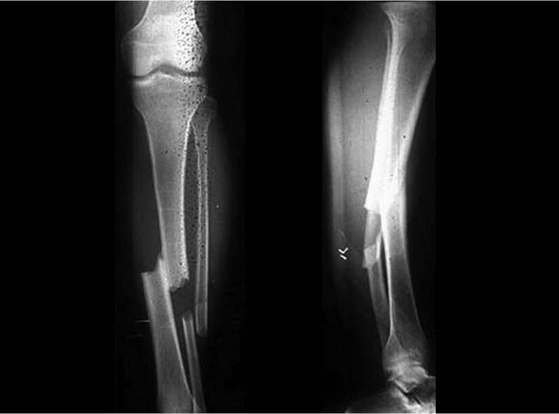 Gãy xương mác nên mổ hay bó bột tốt hơn 3