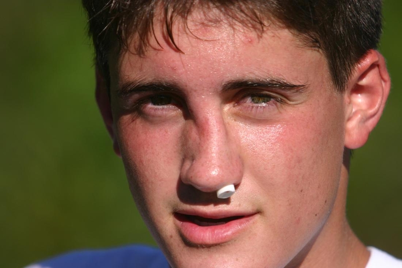 Tổng quan về tình trạng gãy xương mũi 3