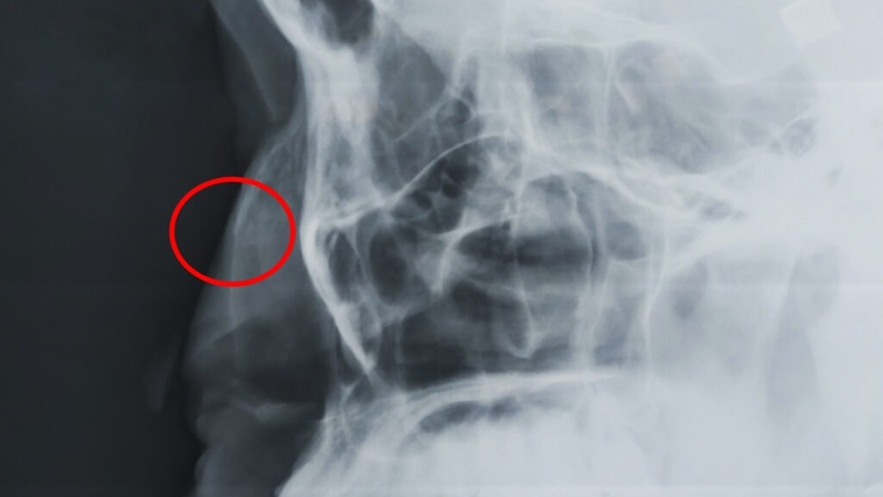 Gãy xương mũi có tự lành không và cách chữa trị như thế nào? 1