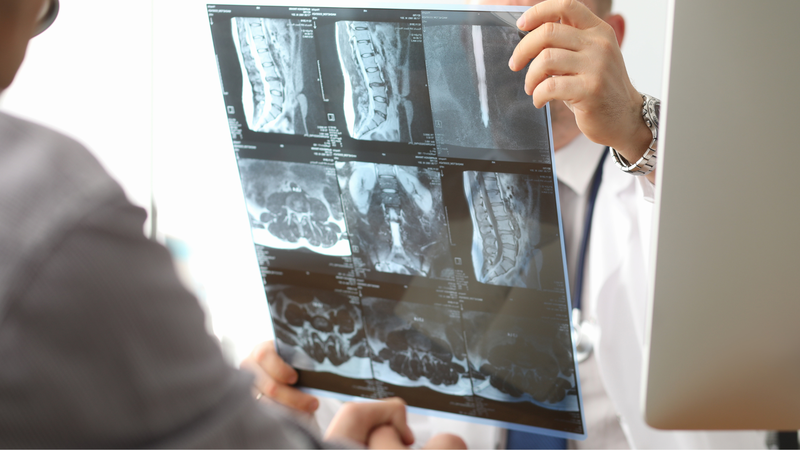 Gãy xương sống bao lâu thì lành? Phương pháp điều trị2