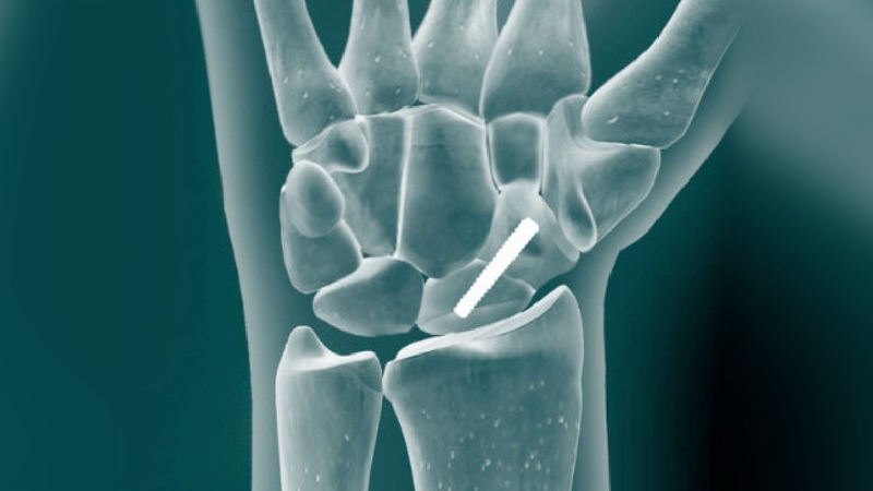 Gãy xương thuyền cổ tay do đâu? Triệu chứng và biến chứng của bệnh 3