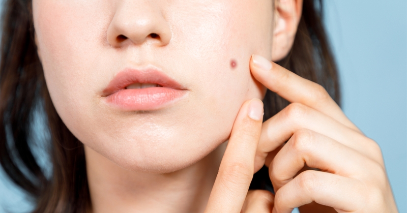 Gel trị mụn Decumar bà bầu dùng được không?