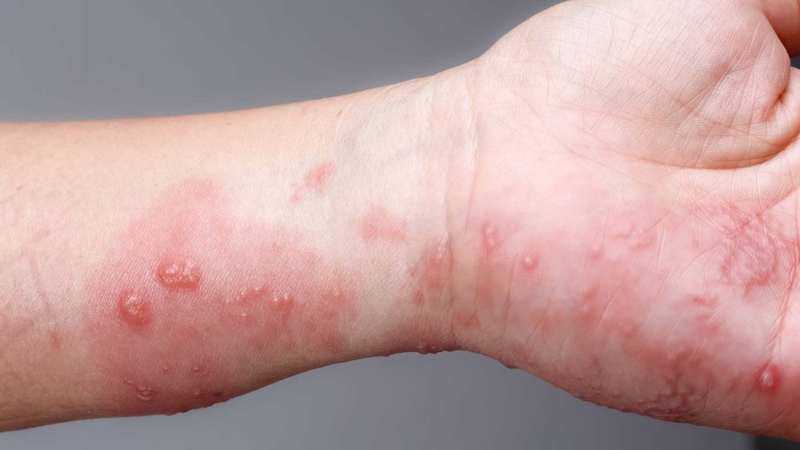 Ghẻ ngứa là gì? Hướng dẫn những cách trị ghẻ ngứa tại nhà an toàn, hiệu quả 1