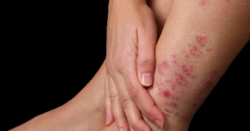 Ghẻ ngứa là gì? Hướng dẫn những cách trị ghẻ ngứa tại nhà an toàn, hiệu quả 2