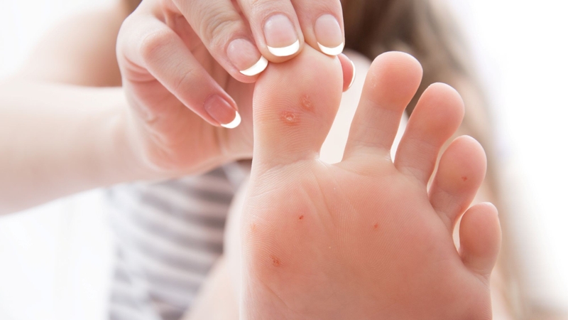 Ghẻ nước ở chân là gì? Chữa trị như thế nào? 1