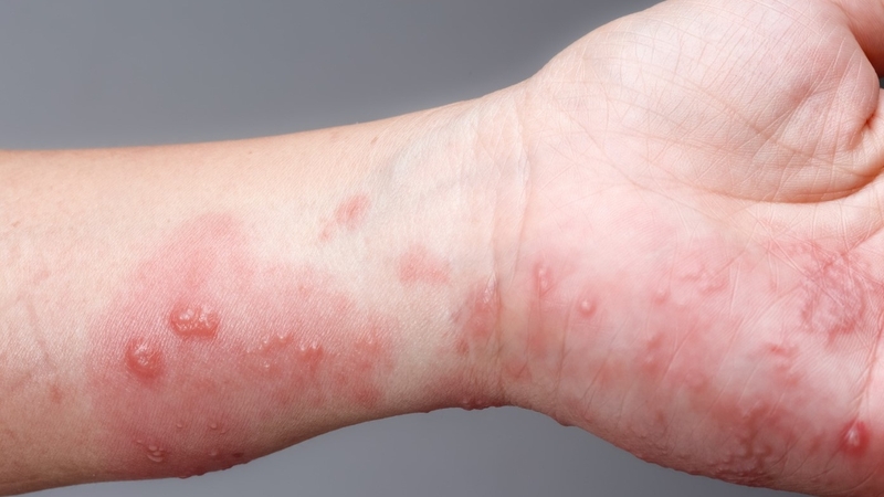 Ghẻ nước ở tay: Nguyên nhân, triệu chứng và phương pháp điều trị 2