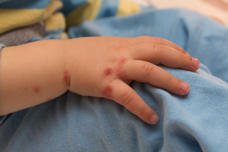 Ghẻ nước ở trẻ là gì? Có để lại biến chứng không? 2