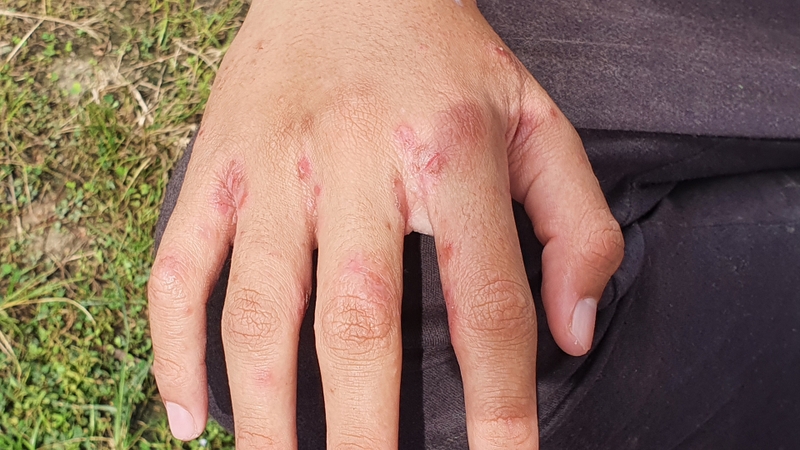 Ghẻ phỏng có để lại sẹo không? Giải đáp từ chuyên gia và cách phòng tránh hiệu quả 2