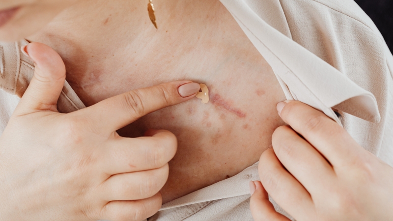 Ghẻ phỏng có để lại sẹo không? Giải đáp từ chuyên gia và cách phòng tránh hiệu quả 3