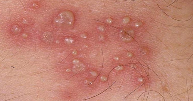 Ghẻ phỏng là bệnh gì? Có chữa được không? 2