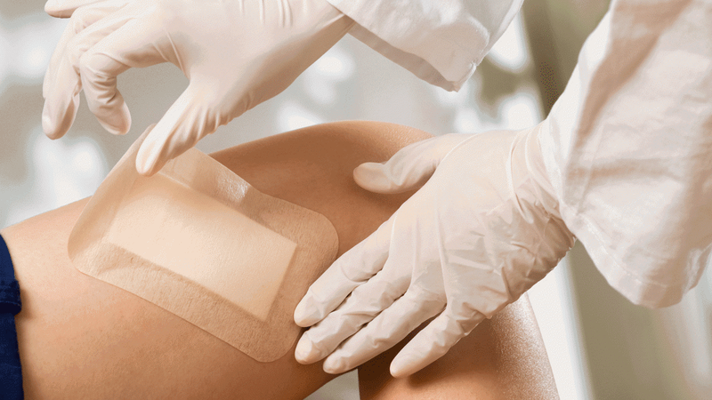 Ghép da là gì? Những điều bạn cần biết về phương pháp ghép da 3