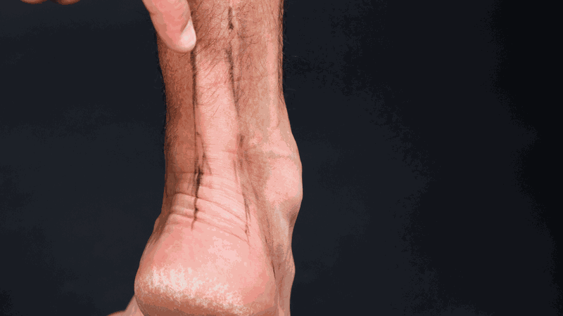 Ghép gân là gì? Những lưu ý cần biết 2