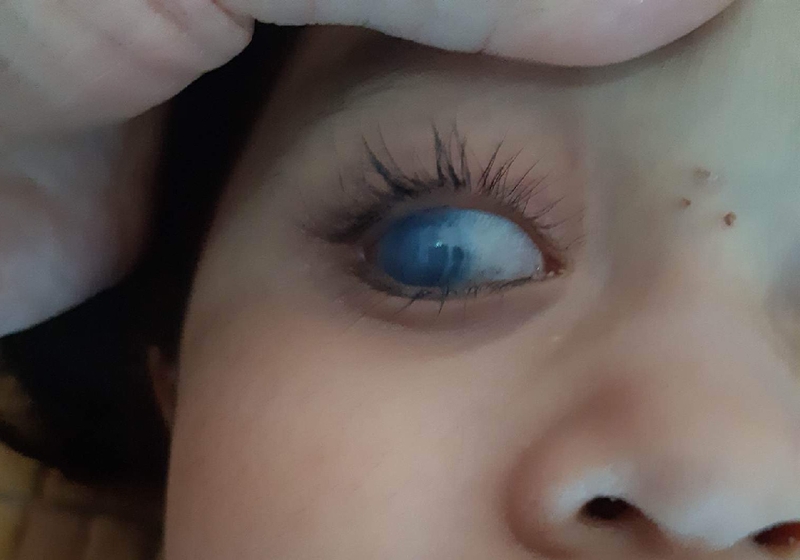 Ghép giác mạc và những điều bạn cần biết trước khi thực hiện-1