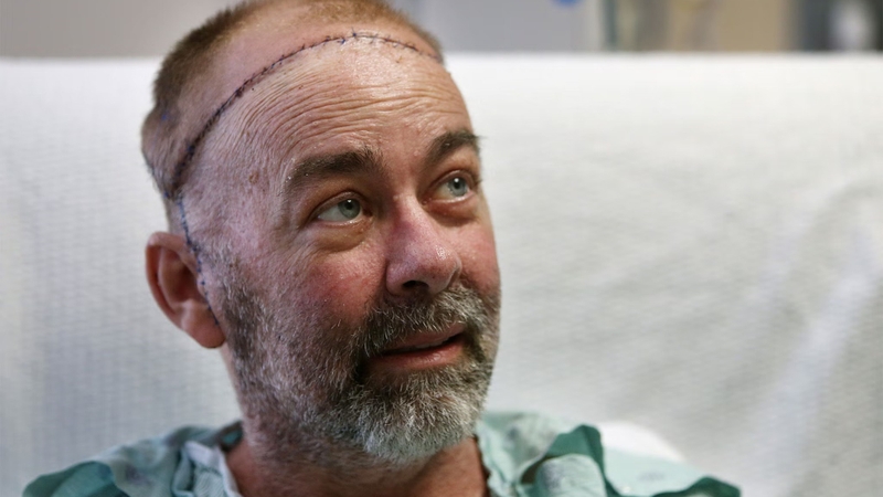 Ghép sọ nhân tạo chi phí bao nhiêu 1