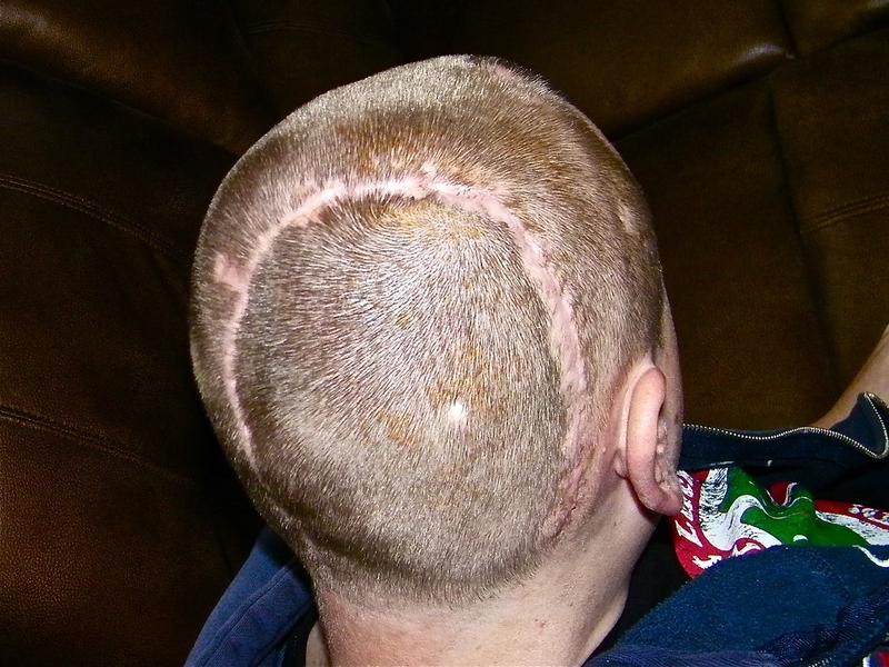 Ghép sọ nhân tạo là gì? Áp dụng trong các trường hợp nào? 2