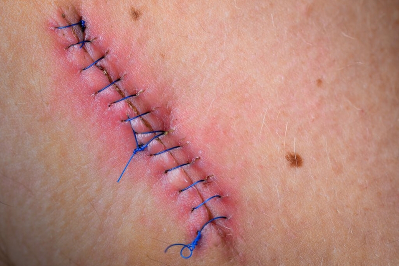 Ghép sọ tự thân: Quy trình, chi phí thực hiện phẫu thuật 2