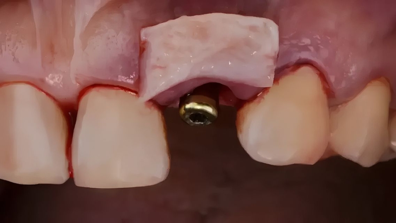 Ghép xương hàm có thể hỗ trợ chuẩn bị nền xương cho cấy ghép implant