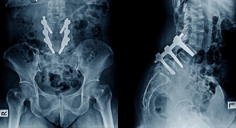 Ghép xương: Phương pháp khôi phục và tái tạo xương sau chấn thương 2