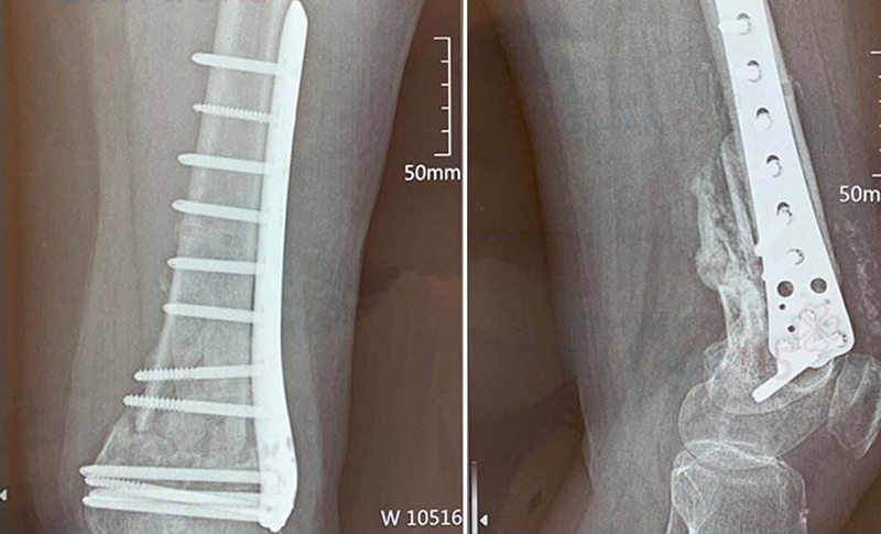Ghép xương: Phương pháp khôi phục và tái tạo xương sau chấn thương 1