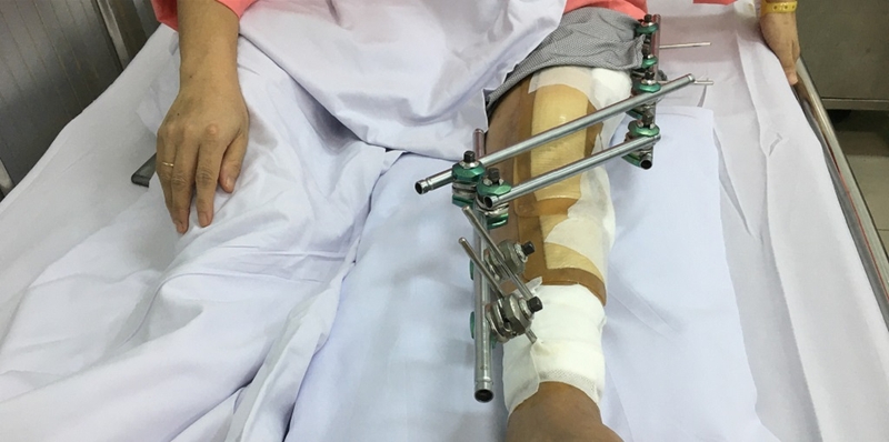 Ghép xương: Phương pháp khôi phục và tái tạo xương sau chấn thương 3