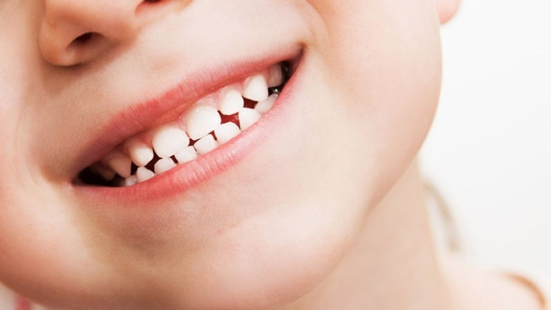 Giá niềng răng cho trẻ 10 tuổi là bao nhiêu? Có lưu ý gì khi thực hiện? 1