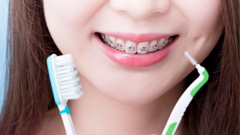 Giá niềng răng cho trẻ 10 tuổi là bao nhiêu? Có lưu ý gì khi thực hiện? 4