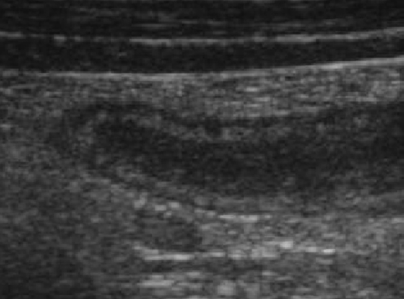 Giá trị của siêu âm ruột thừa trong việc chẩn đoán bệnh  3