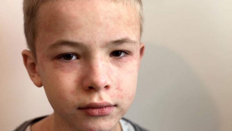 Giá vắc xin sởi quai bị rubella hiện nay là bao nhiêu? 1