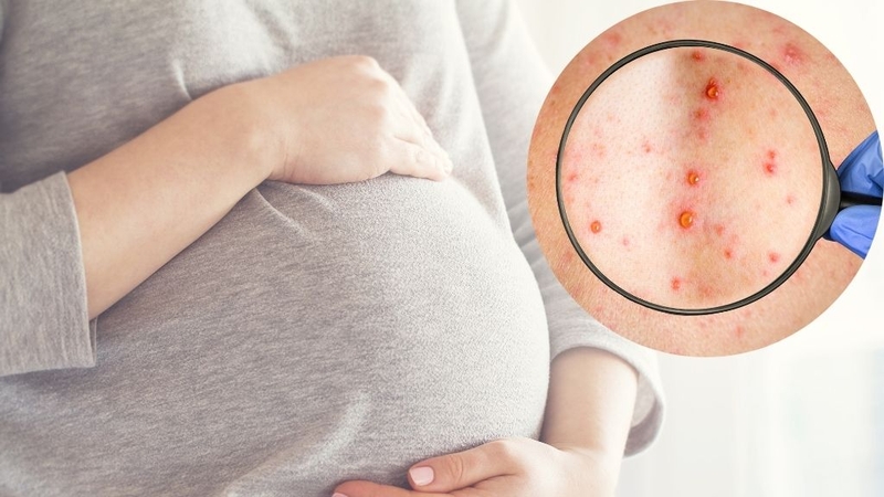 Giá vắc xin sởi quai bị rubella hiện nay là bao nhiêu? 2