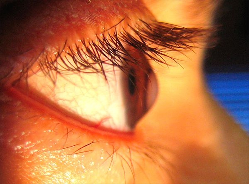 Mách bạn những thông tin quan trọng của bệnh giác mạc hình nón 1