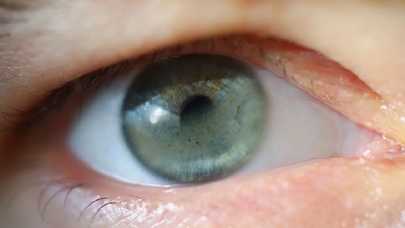 Giác mạc dải băng là gì? Dấu hiệu nhận biết và nguyên nhân gây bệnh 1