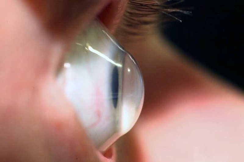 Mách bạn những thông tin quan trọng của bệnh giác mạc hình nón 2