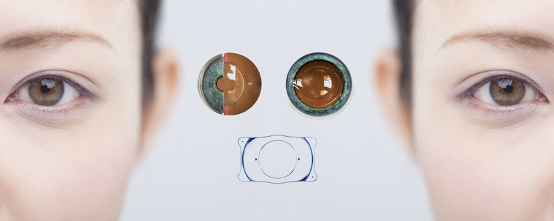 Giác mạc mỏng có mổ cận được không?-3