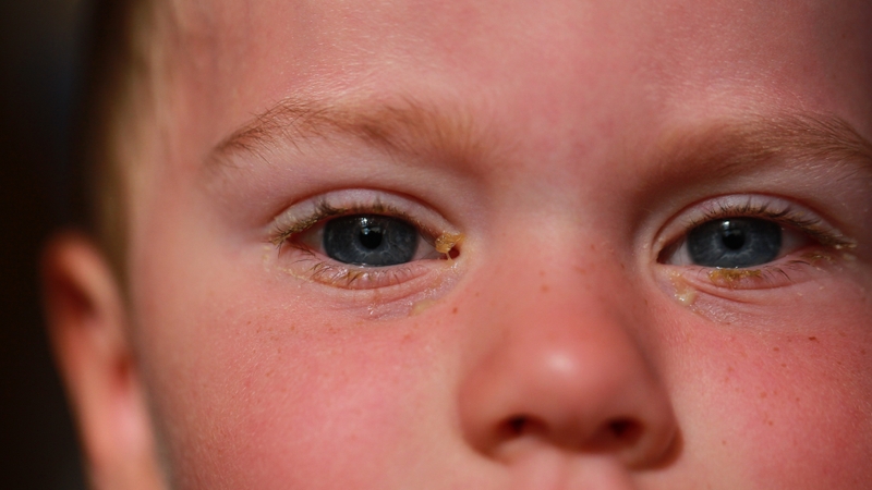 bé bị đau mắt đỏ dùng thuốc gì 2