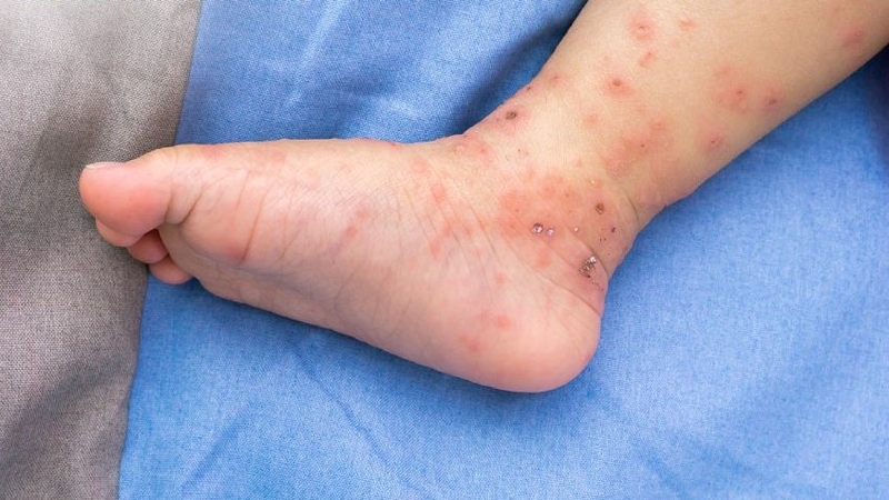 Giải đáp: Bệnh tay chân miệng có ngứa không? 6