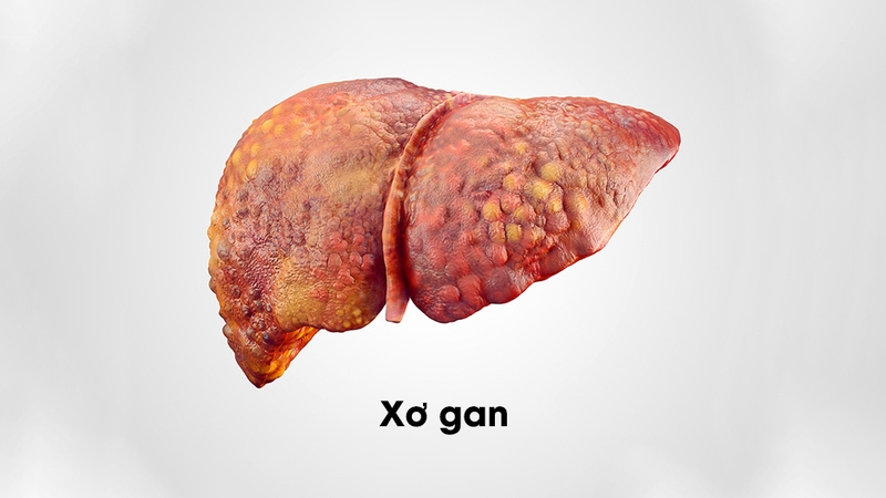 Giải đáp: Bệnh xơ gan có lây không Cách phòng chống là gì 1