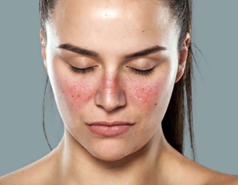 [GIẢI ĐÁP] Bị bệnh lupus ban đỏ hệ thống khi mang thai có sao không? 1