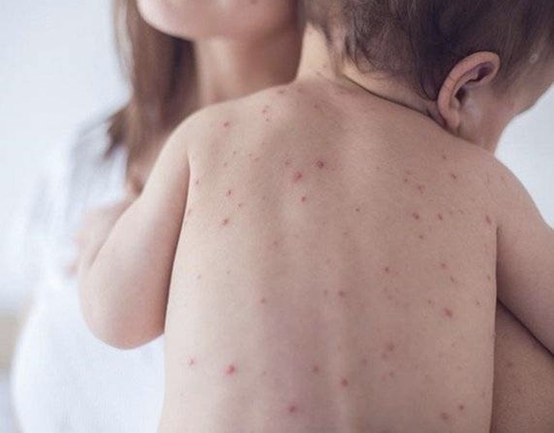 [GIẢI ĐÁP] Bị bệnh lupus ban đỏ hệ thống khi mang thai có sao không? 2