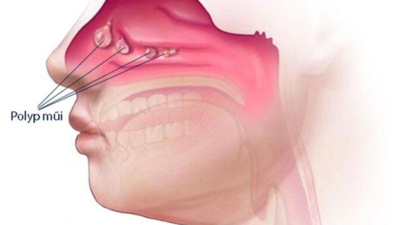Giải đáp: Bị polyp mũi có nên mổ không? 2