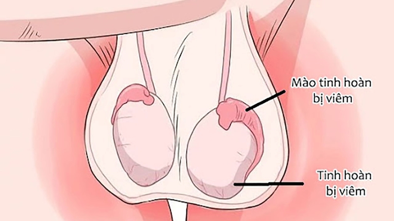 Giải đáp: Biến chứng quai bị ở nam giới có ảnh hưởng đến sức khỏe sinh sản không? 2