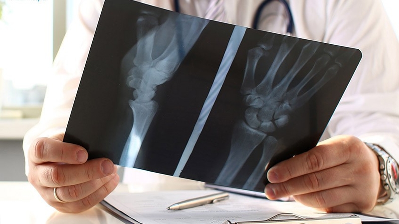 Giải đáp: Biến chứng xương không lành sau gãy và những dấu hiệu xương không lành dễ nhận biết 5