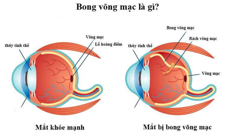 Bong võng mạc là gì?