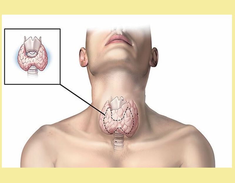 [GIẢI ĐÁP] Bướu cổ là gì? Bệnh bướu cổ nguy hiểm không?1