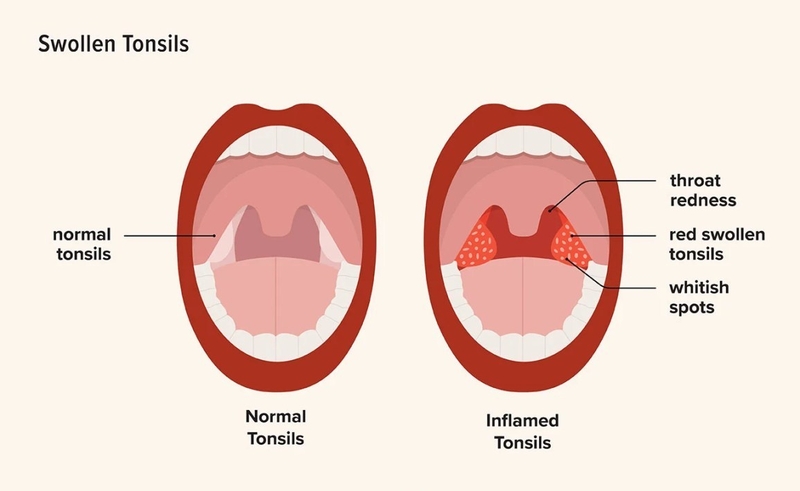 Giải đáp: Cắt amidan có ảnh hưởng đến giọng nói không? 1