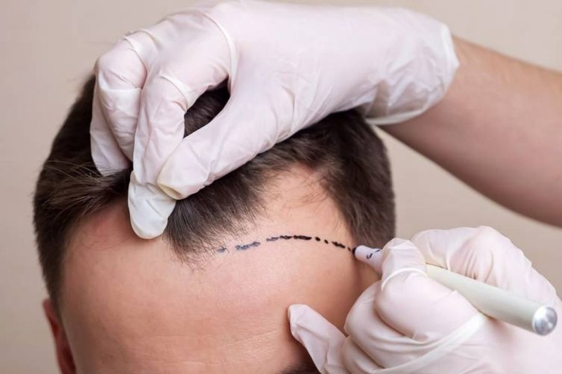 Về mặt kỹ thuật, cấy tóc là một thủ thuật can thiệp nhằm phân bổ đều vị trí của tóc trên da đầu