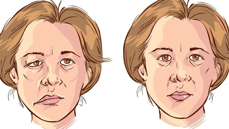 Liệt dây thần kinh số 7 thường biểu hiện bằng việc mặt bị lệch